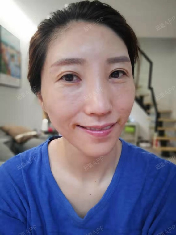上海眶隔脂肪释放好不好_效果图_青山如故眶隔脂肪释放术后第1天_新氧