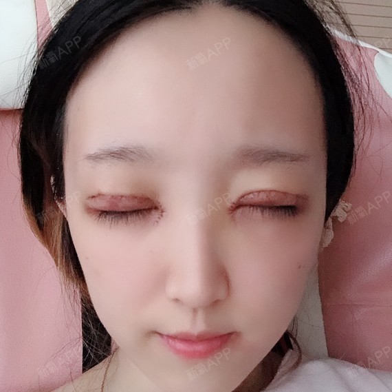今天是切开双眼皮开眼角第三天今天是术后第三天了刚做_圈子-新氧美容