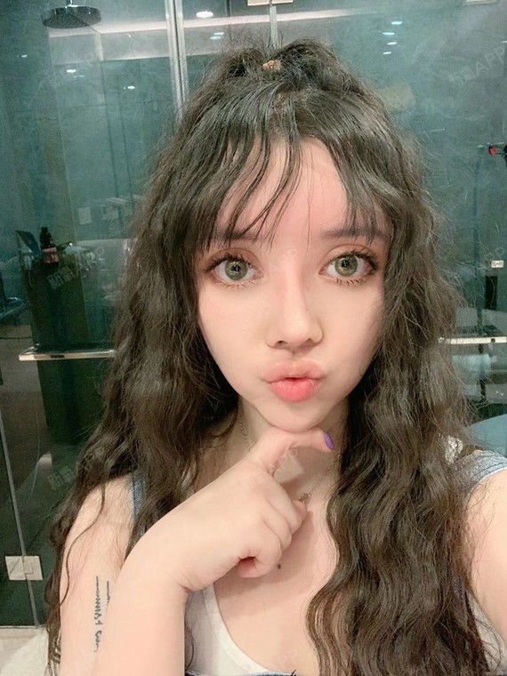 人中缩短术好不好_效果图_大卷妹人中缩短术术后第10天_新氧美容整形