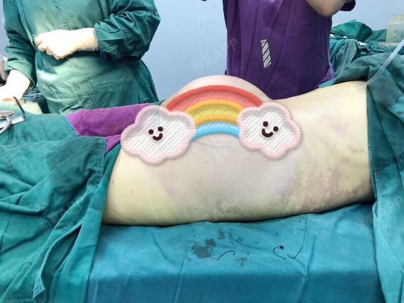 成形术好不好_效果图_小奶瓶美丽记腹壁成形术术后第0天_新氧美容整形