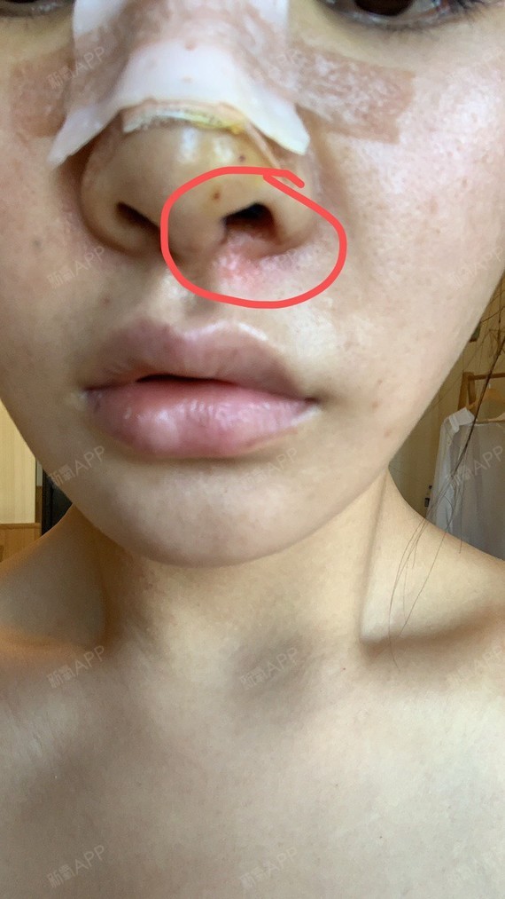 今天起来右边鼻孔下面长了好多小泡,以为是感染,吓得_圈子-新氧美容