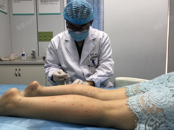 注射瘦小腿