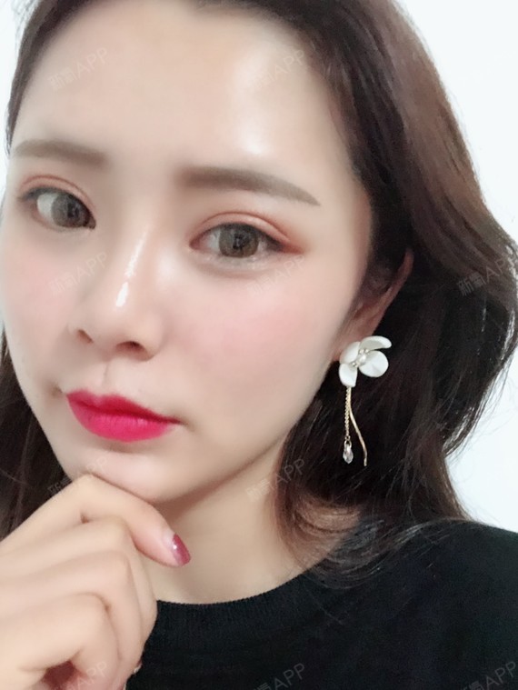 下眼下至术好不好_效果图_氧气zo5n9下眼下至术术后第72天_新氧美容