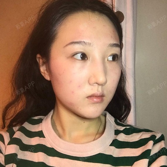 微针美塑项目术后第54天 真的是改善太大了.