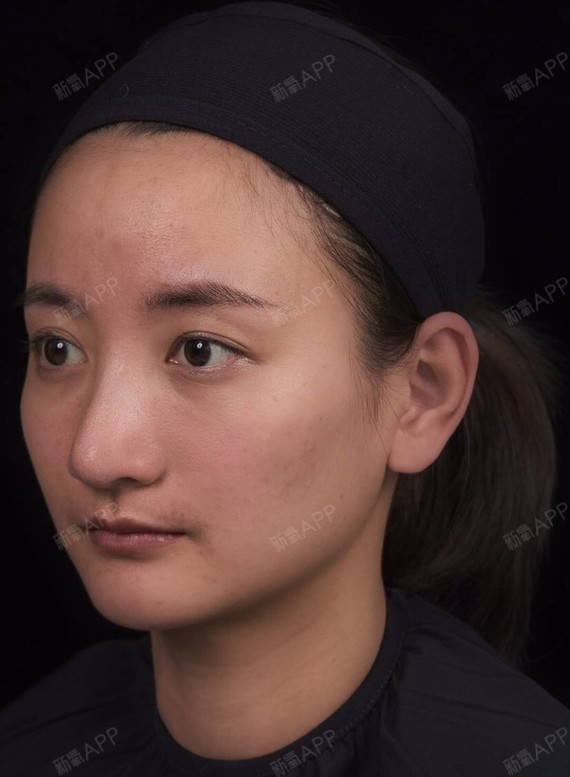 玻尿酸填充面颊