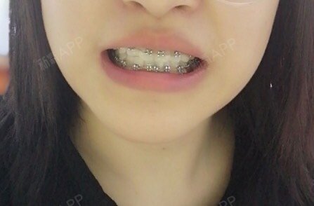 我的牙齿主要就一个问题,左上3号牙齿内旋,但是3号_圈子-新氧美容整形