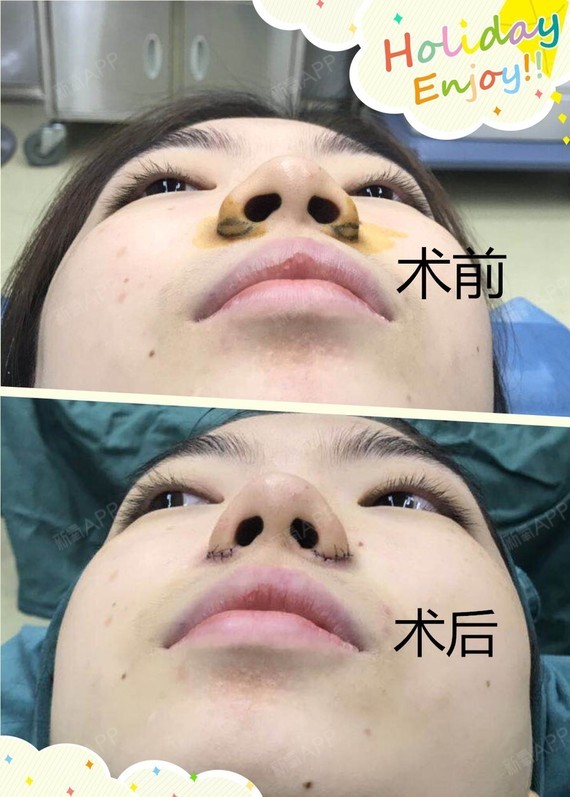 山长水远从香港过来做鼻翼缩小.