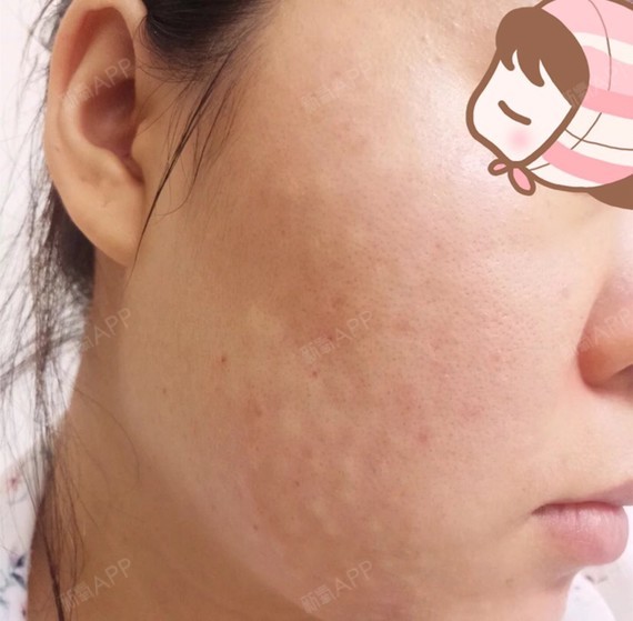 【欣菲聆水光针第36天】 我感觉水光针