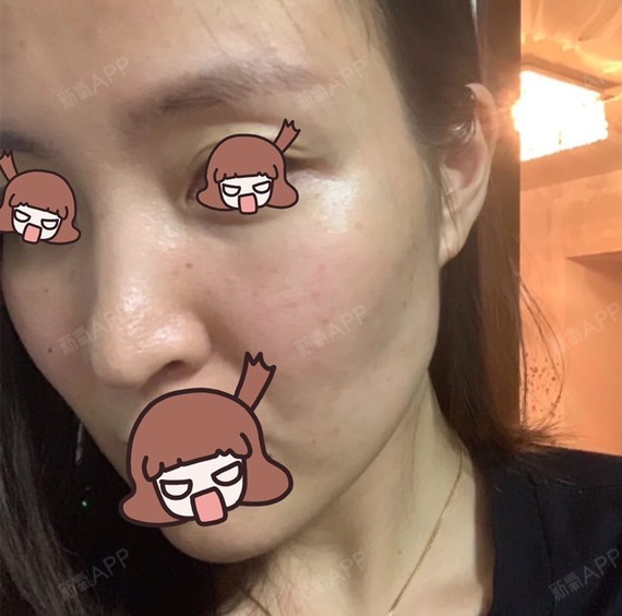 【欣菲聆水光针第15天】 做完水光针半