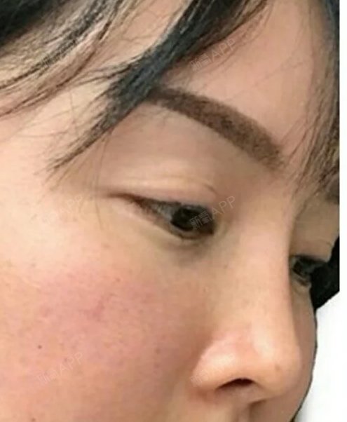 我长得还可以吧,五官周正,浓眉大眼的,但是,脸上_圈子-新氧美容整形