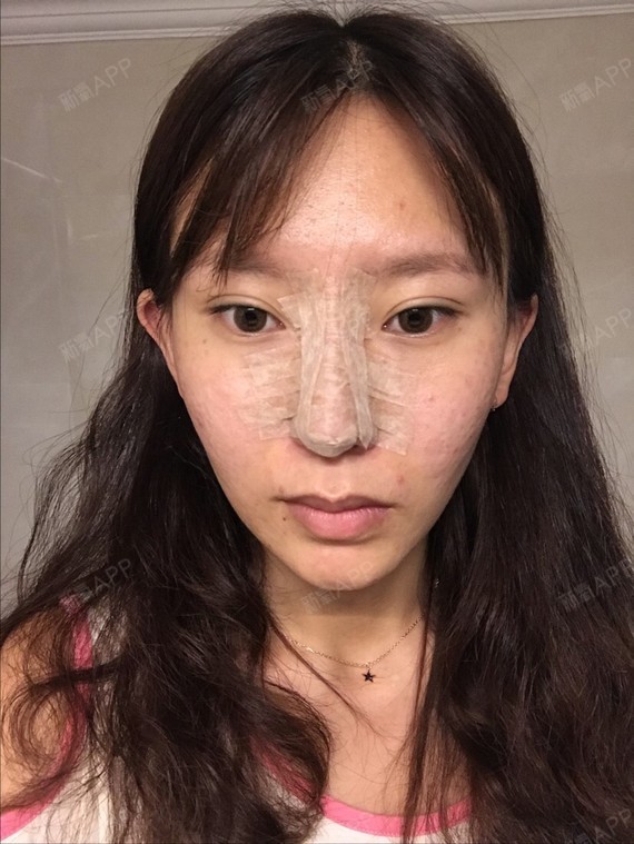 第5天了,鼻子有点肿胀,做完隆鼻后需要忌口,不能吃_圈子-新氧美容整形