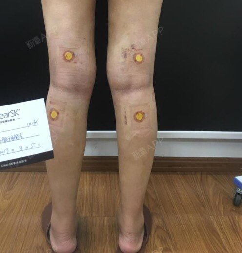 大小腿抽脂十天拆线实拍