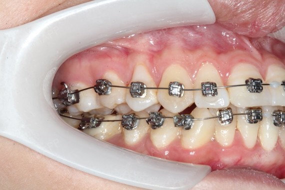 这是一个值得纪念的日子我终于要开始戴牙套了我终于要开始改变了我