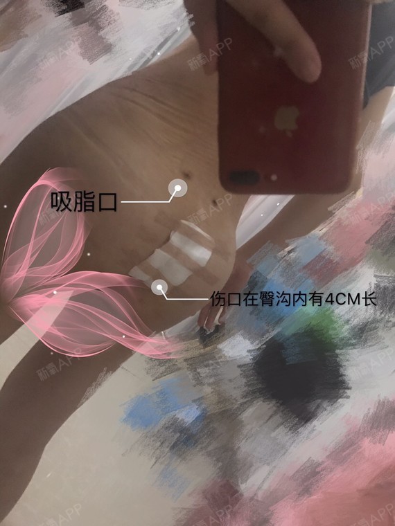 腹壁成形术