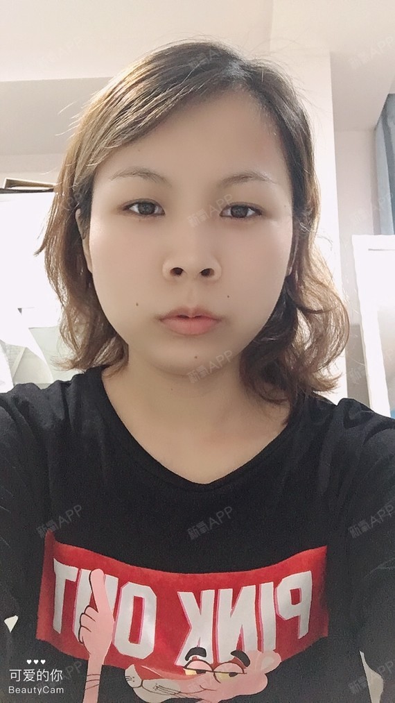 长沙注射瘦脸好不好_效果图_氧气2eezy注射瘦脸术后第10天_新氧美容