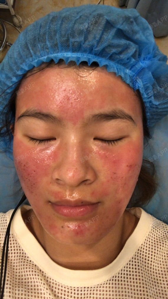 激光祛痘祛痘印