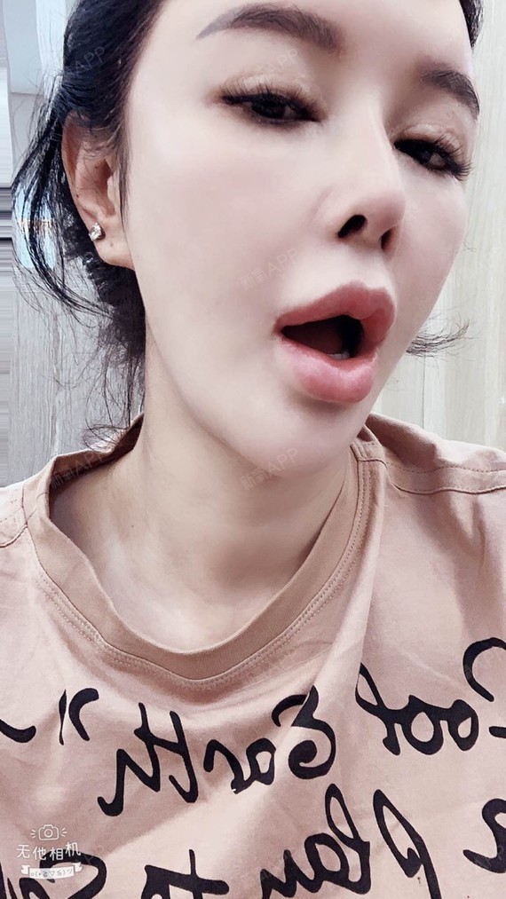 嘴角上扬术好不好_效果图_氧气01ry3嘴角上扬术术后第90天_新氧美容