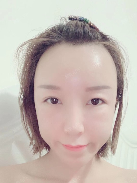 自体脂肪填充额头