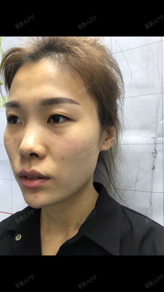 位置:黑龙江哈尔滨美奇国际, 操作医生:崔明玉 新_圈子-新氧美容整形