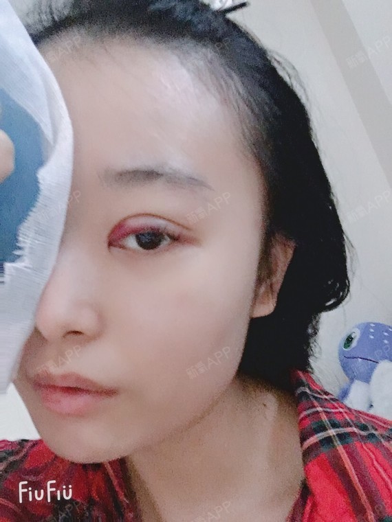 埋线双眼皮