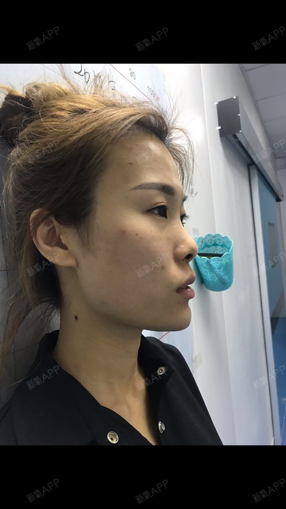 玻尿酸垫下巴好不好_效果图_氧气泡芙泡泡玻尿酸垫下巴术后第93天