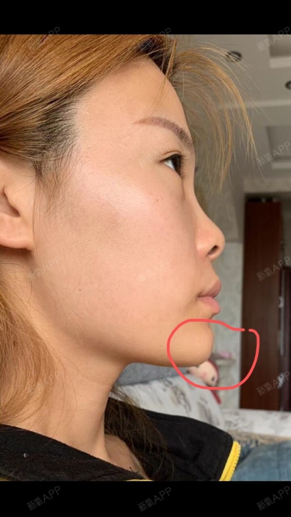 地址:黑龙江哈尔滨美奇国际 操作医生:崔明玉 新氧_圈子-新氧美容整形