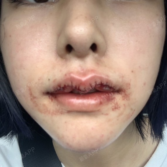 好怪异 嘴角的两坨肉.