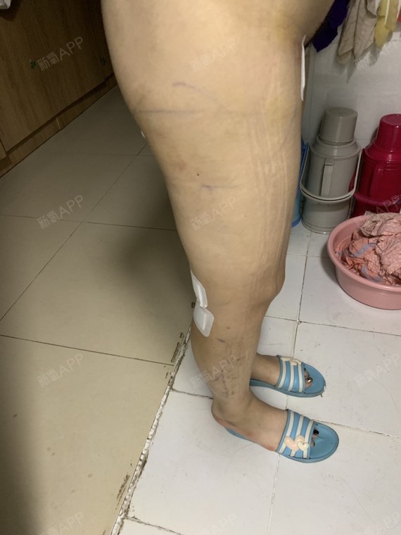 大腿小腿吸脂术后第十天
