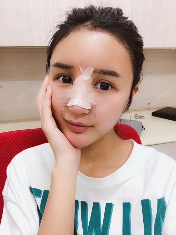 手术缩鼻头好不好_效果图_米可TO手术缩鼻头