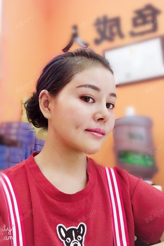重庆酒窝成形术好不好_效果图_仔吉酒窝成形术术后第7天_新氧美容整形