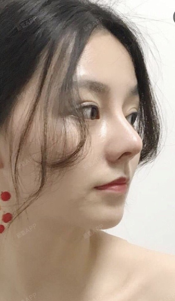 南昌耳软骨复合隆鼻好不好_效果图_宫田泽蛉耳软骨复合隆鼻术后第30天