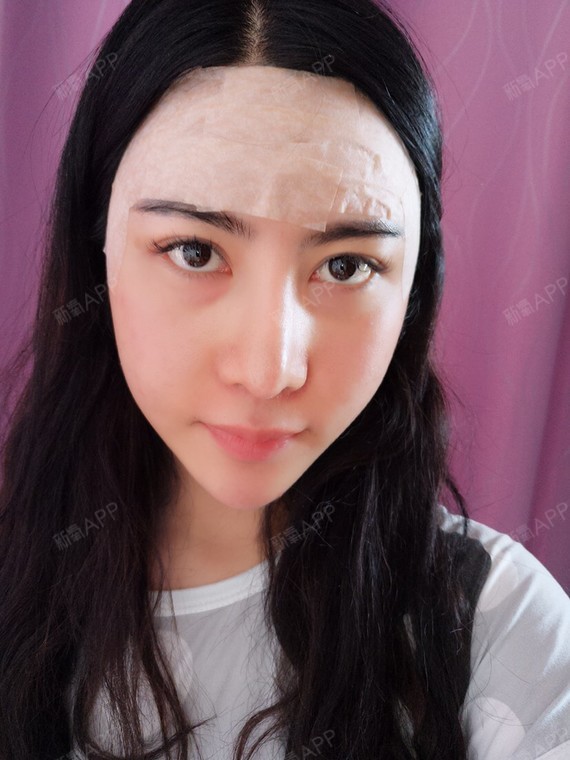 自体脂肪填充额头