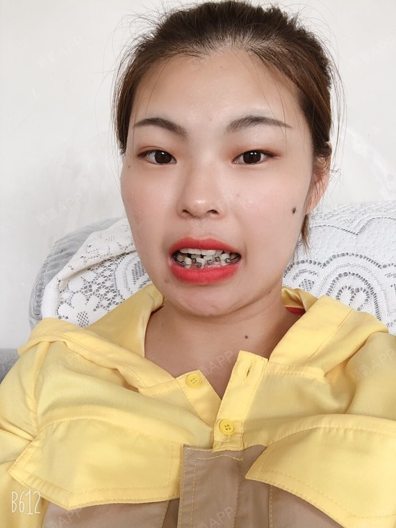 自锁托槽矫正好不好_效果图_铭峻自锁托槽矫正术后第74天_新氧美容
