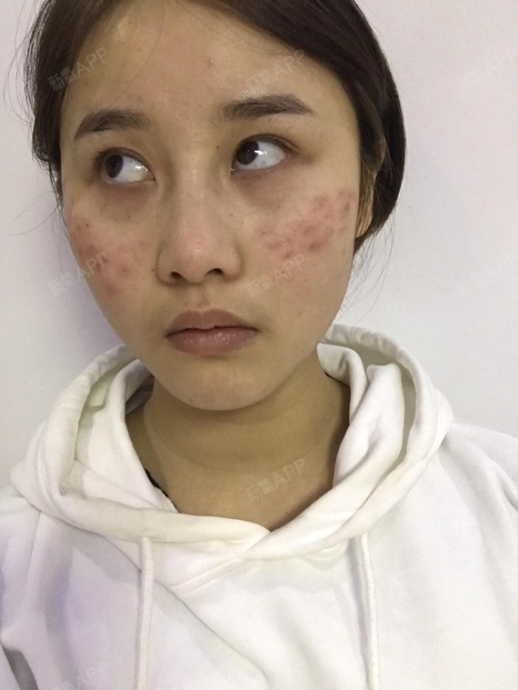 皮秒激光