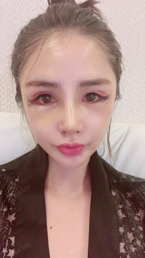 开外眼角好不好_效果图_miamimi开外眼角术后第0天_新氧美容整形