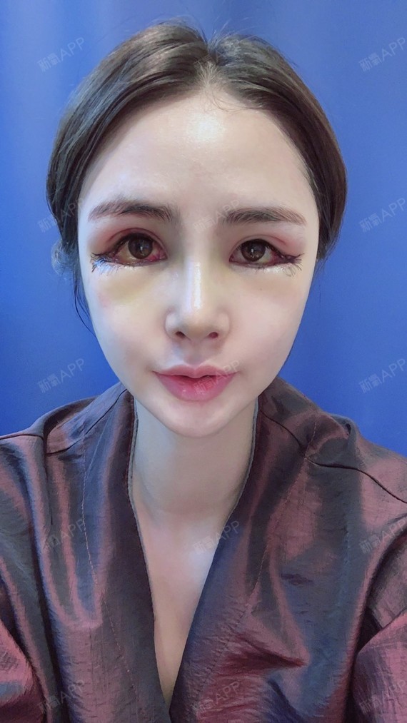 后眼角77下至916号做的不会改新氧这个日期哦04