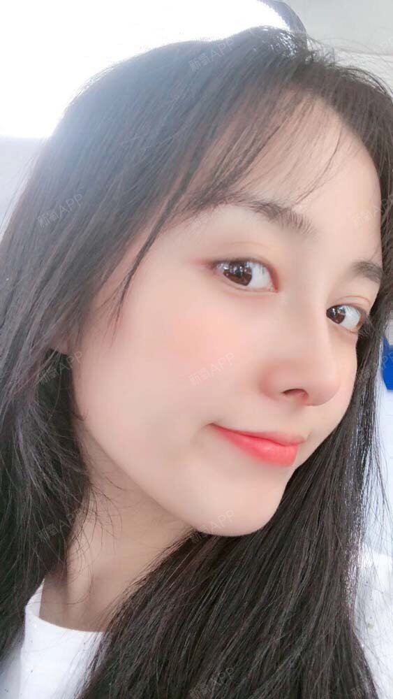 合肥假体垫鼻基底好不好_效果图_氧气32yh7假体垫鼻基底术后第56天
