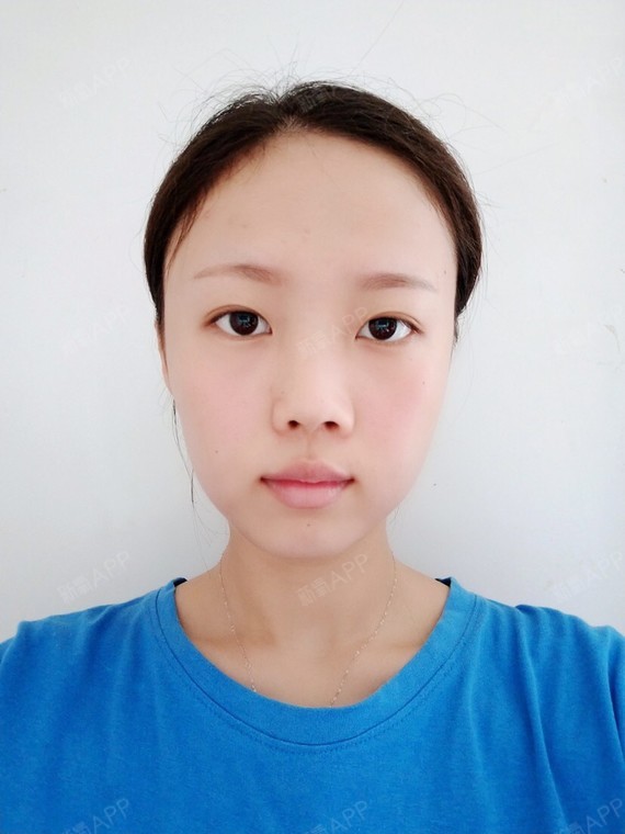 一直就是个矮鼻梁,宽鼻翼,面部整体看起来比较平坦,_圈子-新氧美容