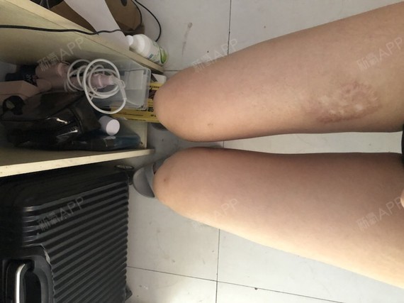 效果图里见 原相机无p图 腿上的疤是小时候烫的哦