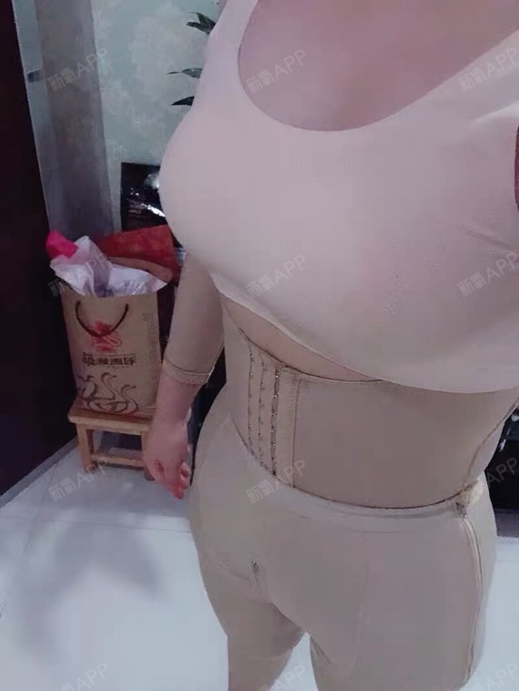 青岛华颜美黄金微雕瘦腰腹术后26天