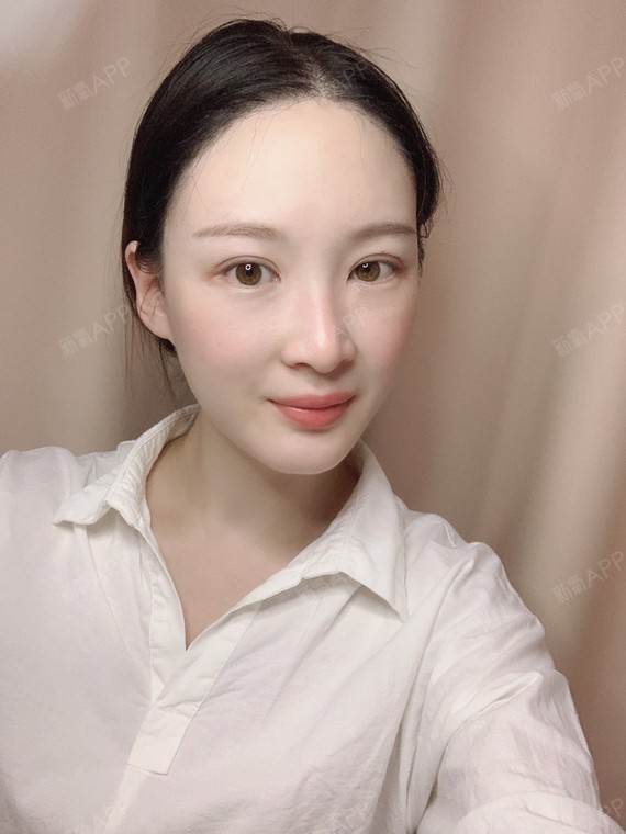 激光祛斑好不好_效果图_芸菡激光祛斑术后第2天_新氧美容整形