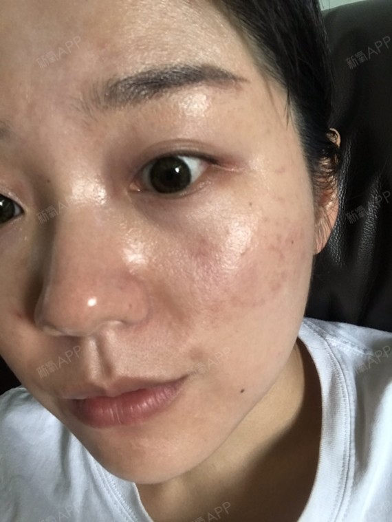 热拉提打卡day2 出痧退得七七八八了!这个项目让_圈子-新氧美容整形