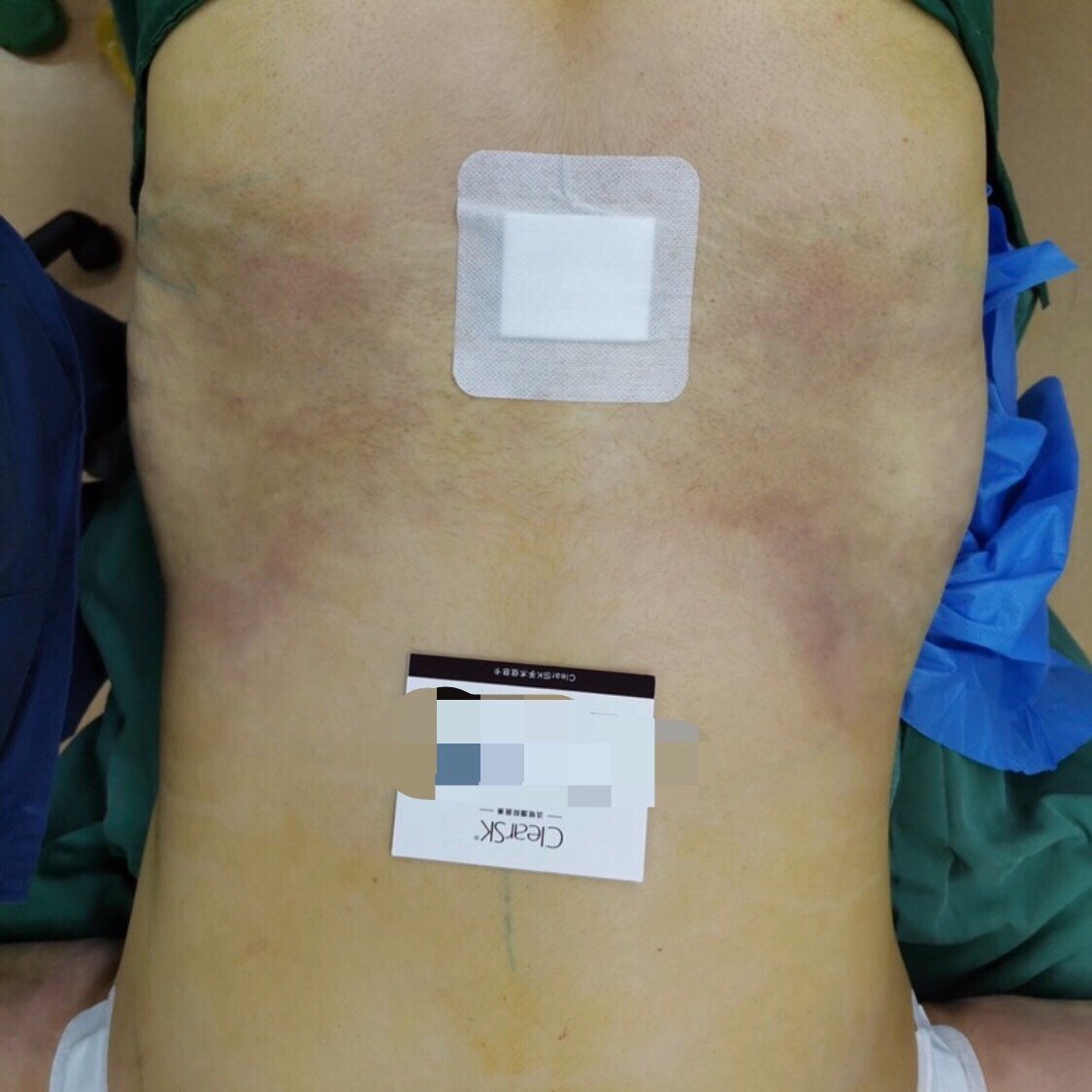 吸脂瘦腰腹怎么样_恢复过程_效果如何_氧气3oeiz整形日记9.