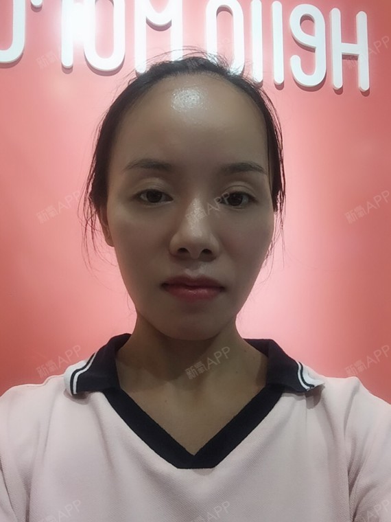 这是我打瘦脸针第八天,已经可以看到效果了.