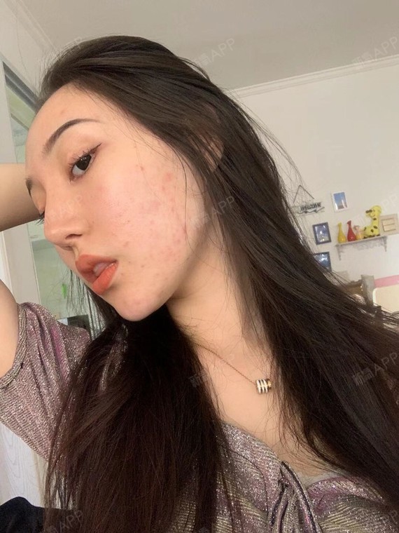 飞顿激光术后第三天啦