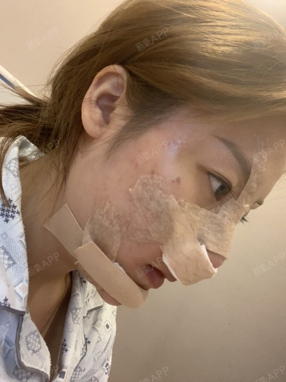 今天是第二天 鼻子取了纱布终于通了