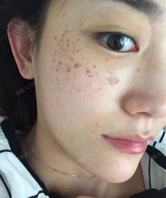 刚刚做完第一天,做了爆破的地方有点红红