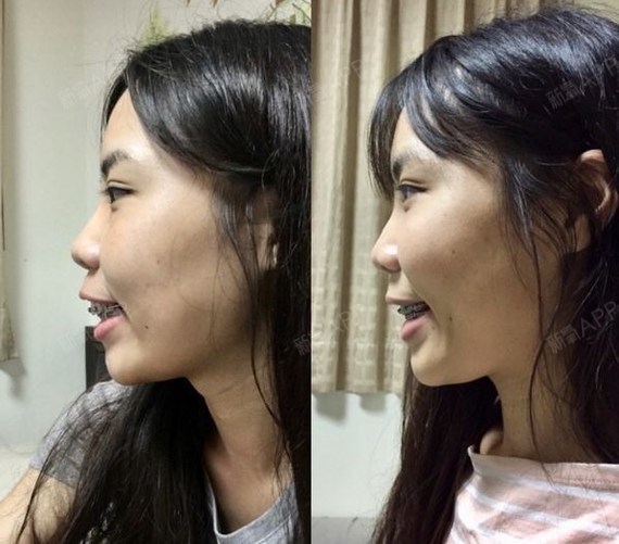 给个侧面看我的牙齿吧……之前来利美康做的牙齿矫正,_圈子-新氧美容