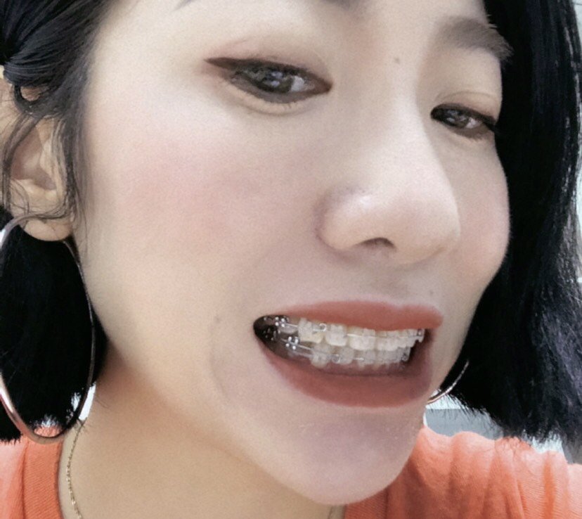 长沙牙祖口腔矫正修复中心sami al sakal医生日记_用户案例-新氧美容