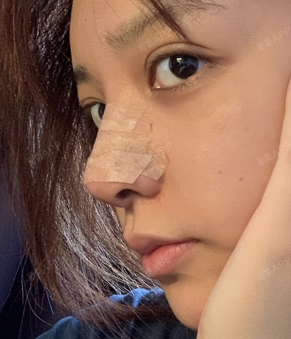 【北京艾菲 耳软骨垫鼻尖 鼻头缩小 鼻翼缩小】_圈子-新氧美容整形